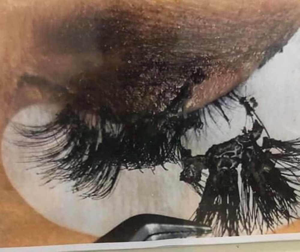 Ir para  <p><big>Uma fotografia circula entre as redes sociais de radiologistas mostrando um c&iacute;lio destru&iacute;do e a pele da p&aacute;lpebra machucada. Os m&eacute;dicos afirmam que o material usado em alongamento de...