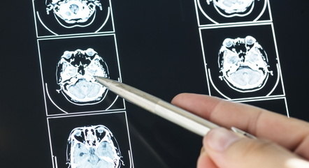 Ir para  <p><big>Pesquisadores do Instituto Kolinska, na Su&eacute;cia, descobriram um novo sinal que pode indicar a doen&ccedil;a de Alzheimer, e que pode ser percebido precocemente.</big></p>

<p><big>As...