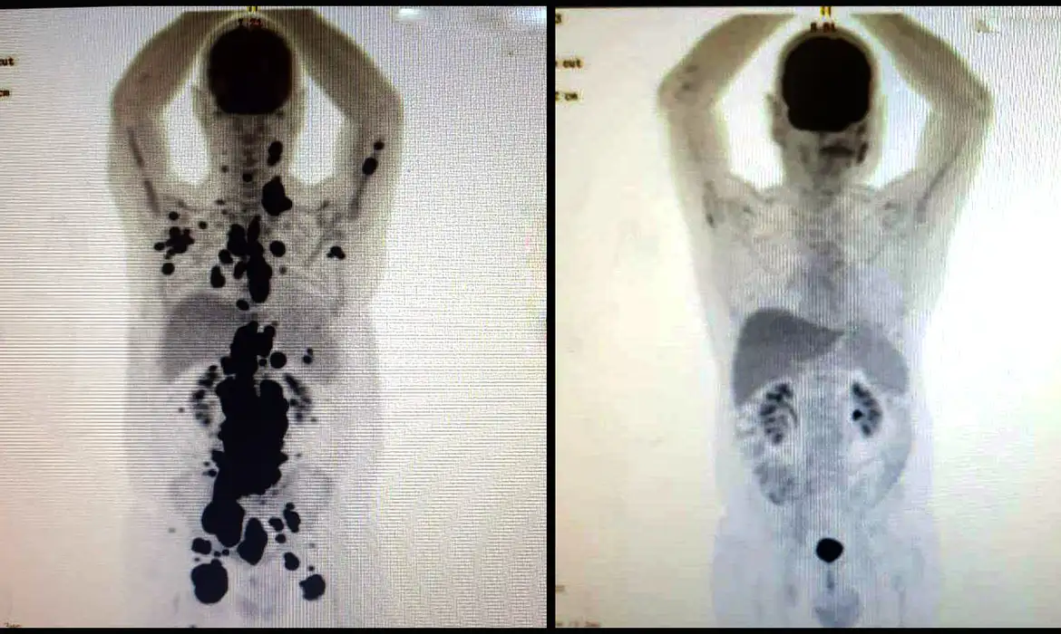 Ir para  <p><big>A terapia celular CAR-T Cell tem obtido resultado importante no tratamento de alguns tipos de c&acirc;ncer, por meio da reprograma&ccedil;&atilde;o das c&eacute;lulas de defesa do corpo. A tecnologia celular...